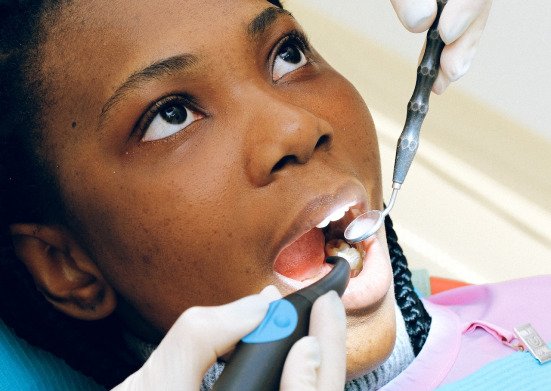 Dental Fillings