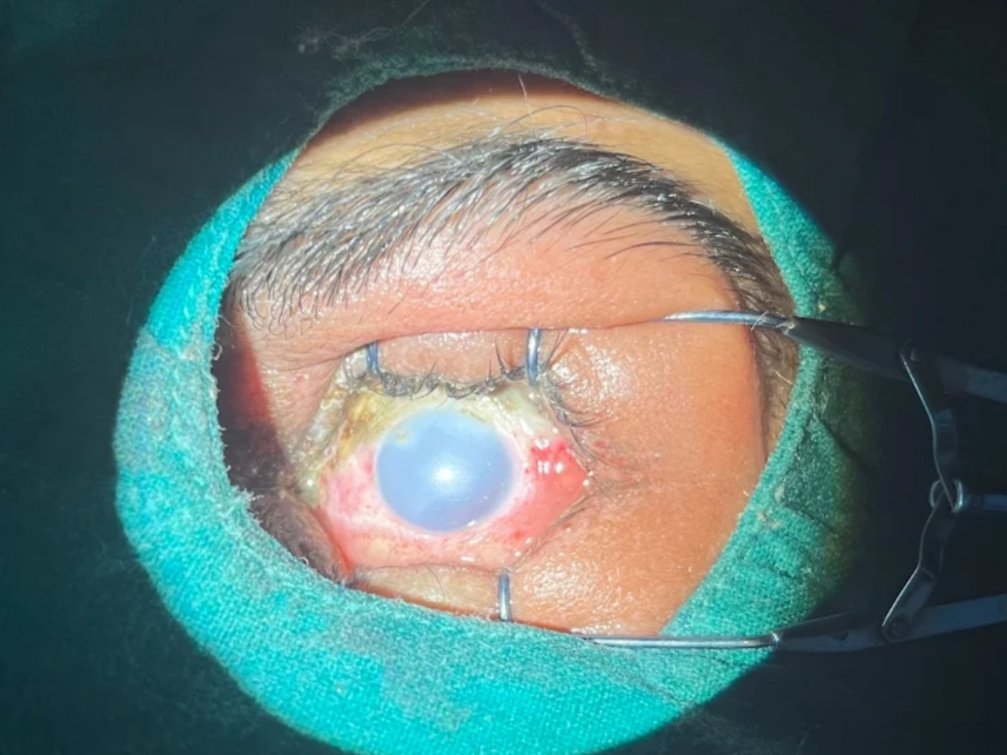 Cataract