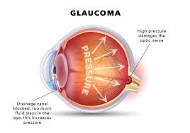 Glaucoma (Kala Motia)