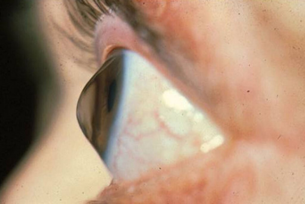 Cornea & Corneal Disorders